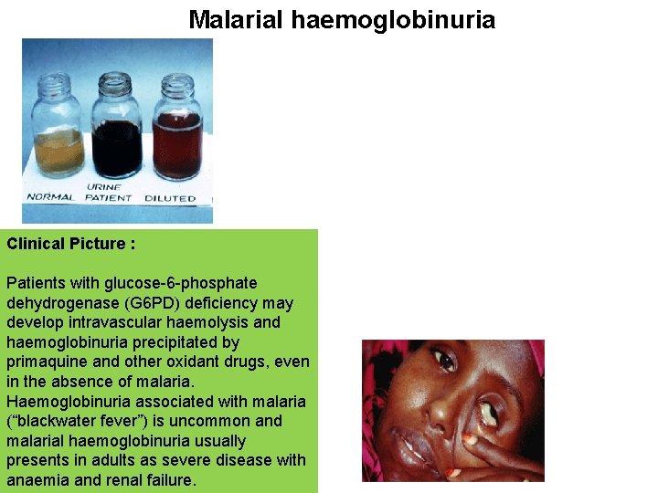 Malarial haemoglobinuria Clinical Picture : Patients with glucose-6 -phosphate dehydrogenase (G 6 PD) deficiency