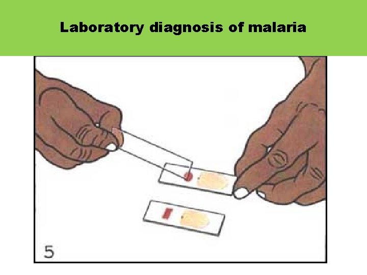Laboratory diagnosis of malaria 