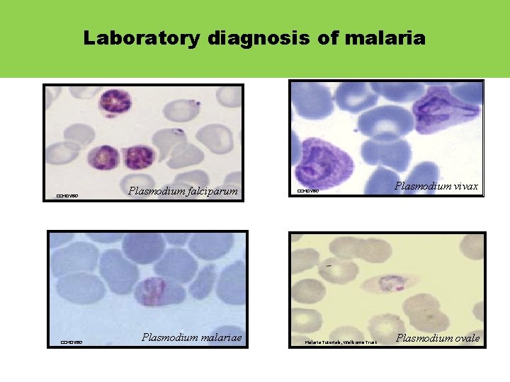 Laboratory diagnosis of malaria CCMOVBD Plasmodium falciparum Plasmodium malariae CCMOVBD Malaria Tutorials, Wellcome Trust