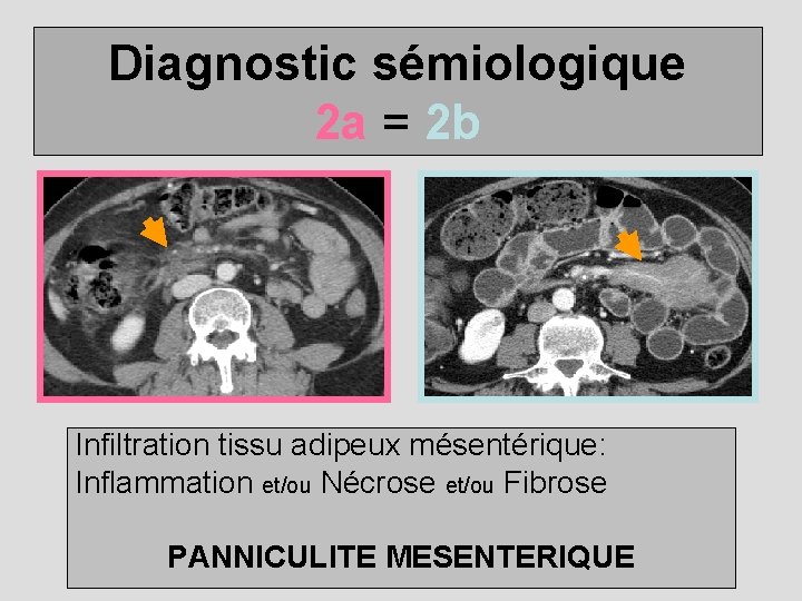 Diagnostic sémiologique 2 a = 2 b Infiltration tissu adipeux mésentérique: Inflammation et/ou Nécrose