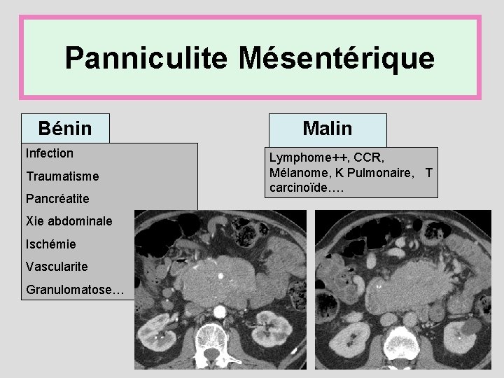 Panniculite Mésentérique Bénin Infection Traumatisme Pancréatite Xie abdominale Ischémie Vascularite Granulomatose… Malin Lymphome++, CCR,