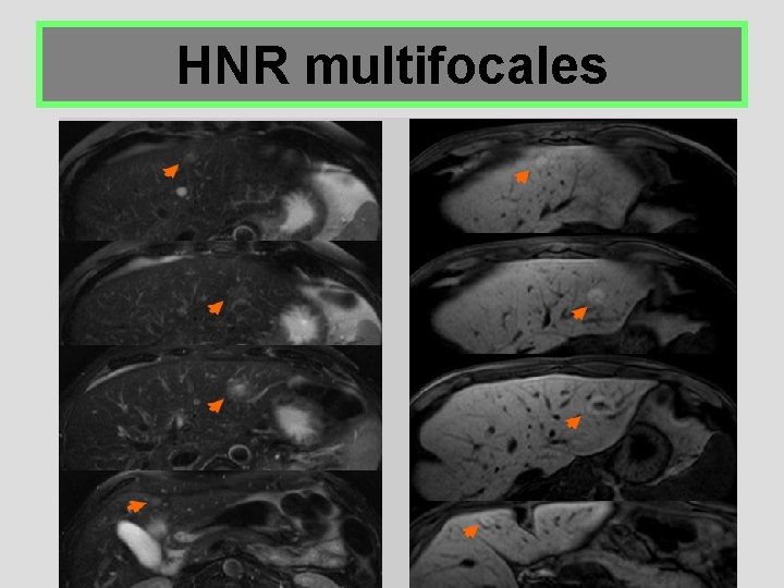 HNR multifocales 