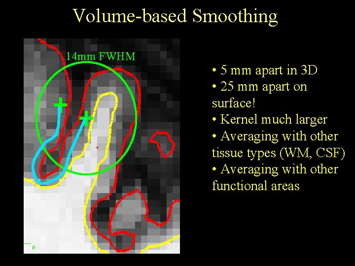 Volume-based Smoothing 14 mm FWHM • 5 mm apart in 3 D • 25