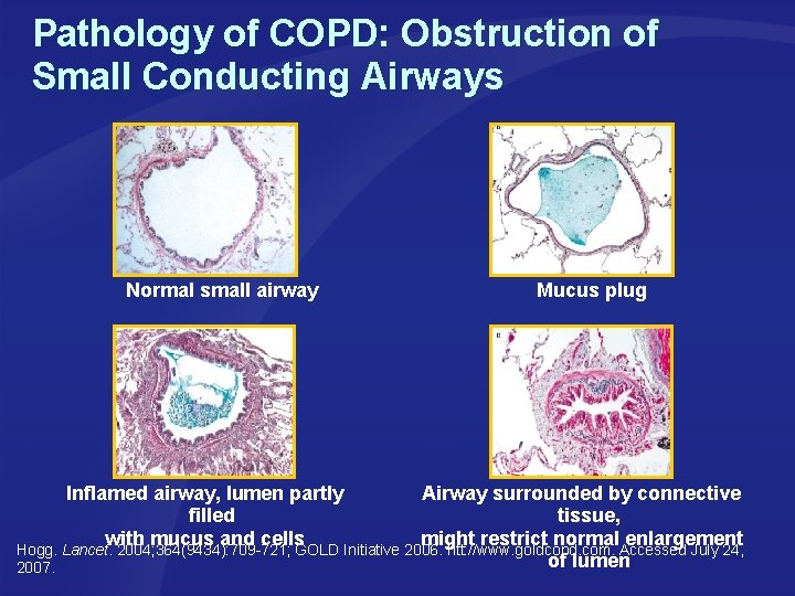 Pathology of COPD: Obstruction of Small Conducting Airways Normal small airway Mucus plug Inflamed