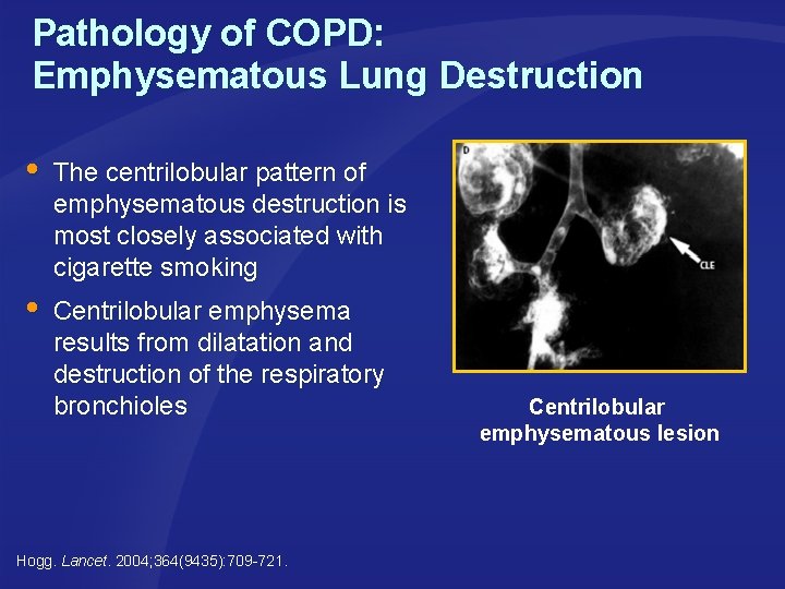 Pathology of COPD: Emphysematous Lung Destruction The centrilobular pattern of emphysematous destruction is most