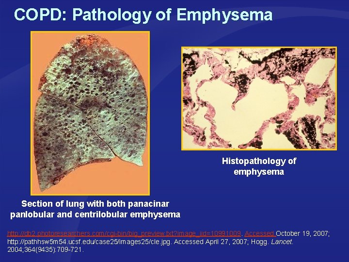 COPD: Pathology of Emphysema Histopathology of emphysema Section of lung with both panacinar panlobular