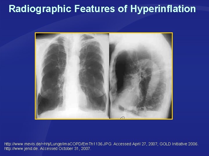 Radiographic Features of Hyperinflation http: //www. mevis. de/~hhj/Lunge/ima. COPD/Em. Th 1136. JPG. Accessed April