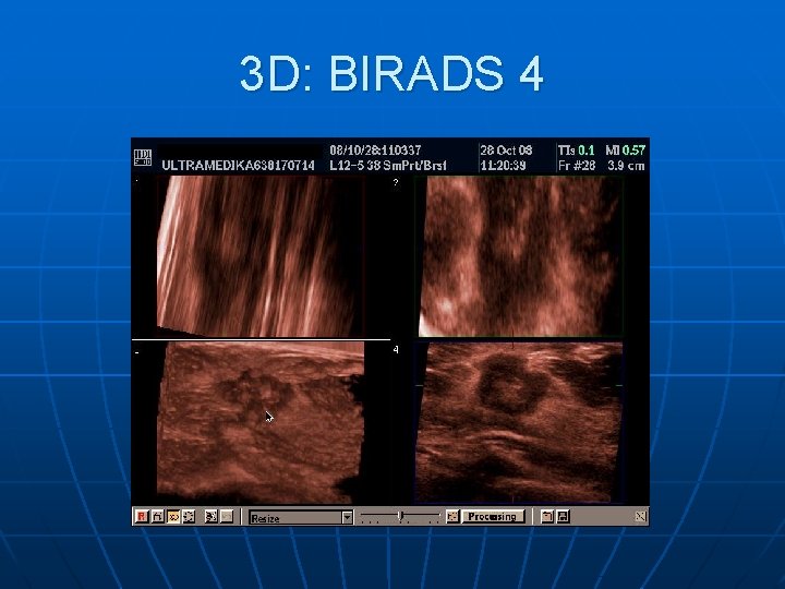 3 D: BIRADS 4 3 D: BIRADS 4
