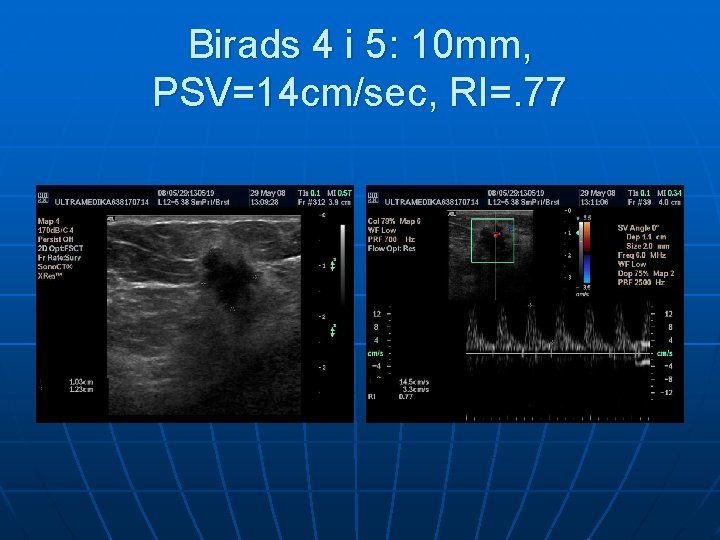 Birads 4 i 5: 10 mm, PSV=14 cm/sec, RI=. 77 Birads 4 i 5: 10 mm, PSV=14 cm/sec, RI=. 77