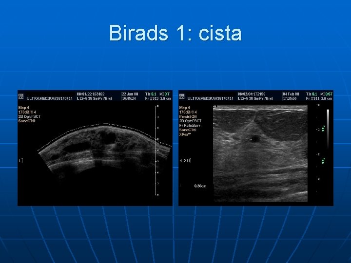 Birads 1: cista 