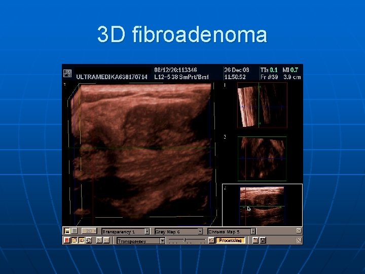 3 D fibroadenoma 