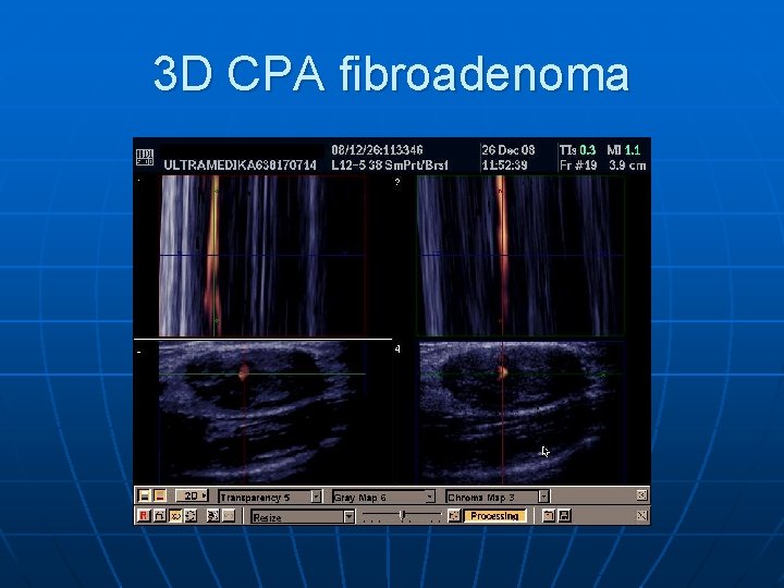 3 D CPA fibroadenoma 3 D CPA fibroadenoma