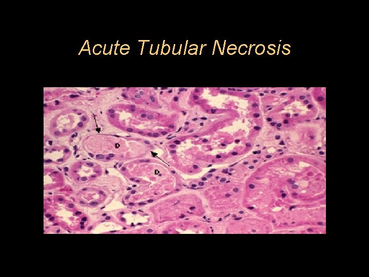 Acute Tubular Necrosis 
