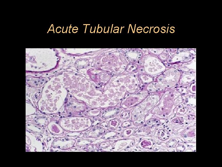 Acute Tubular Necrosis 