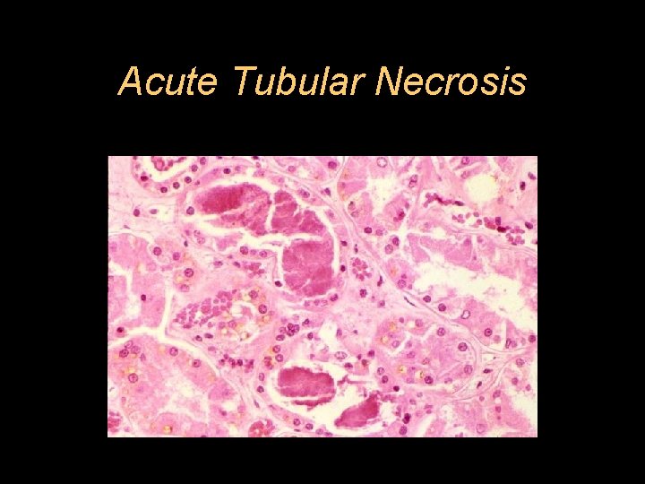 Acute Tubular Necrosis 