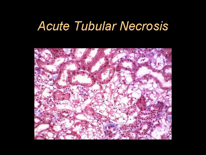 Acute Tubular Necrosis 