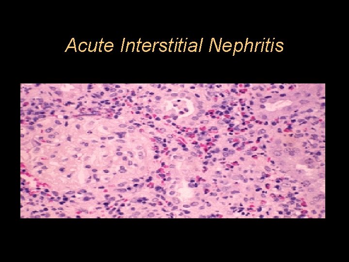 Acute Interstitial Nephritis 