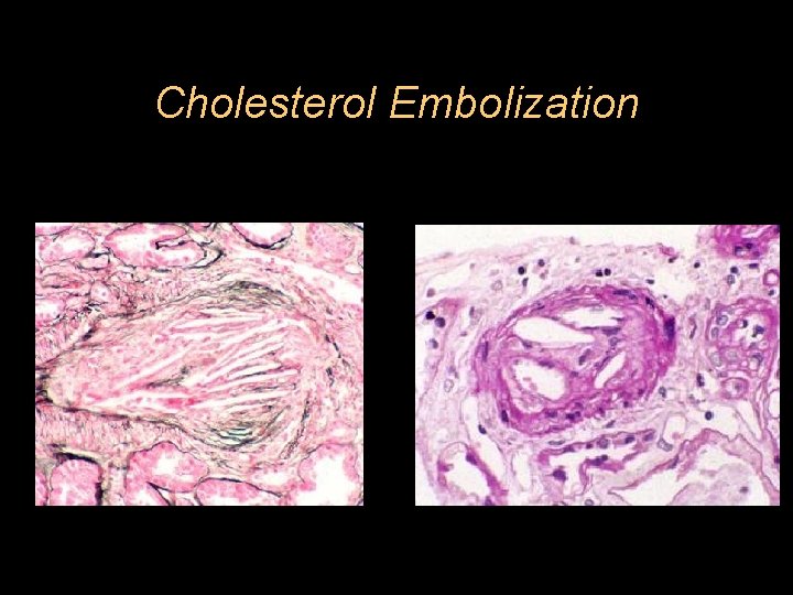 Cholesterol Embolization 