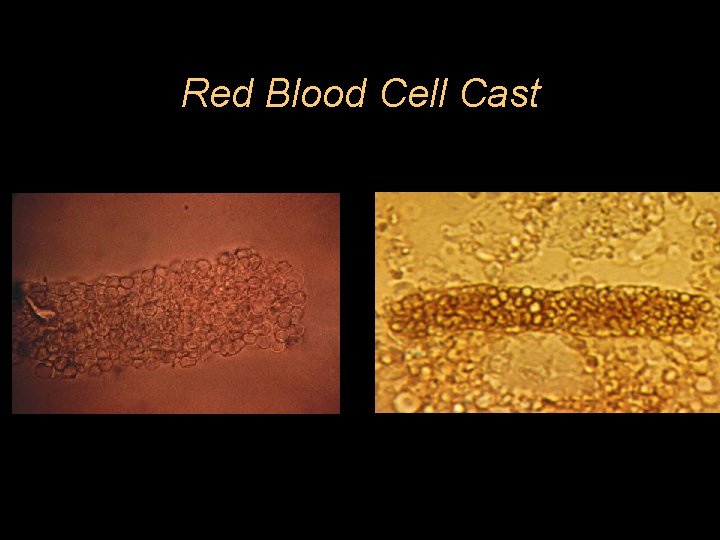 Red Blood Cell Cast 