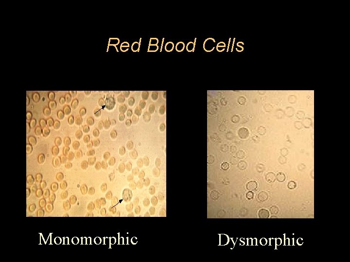 Red Blood Cells Monomorphic Dysmorphic 