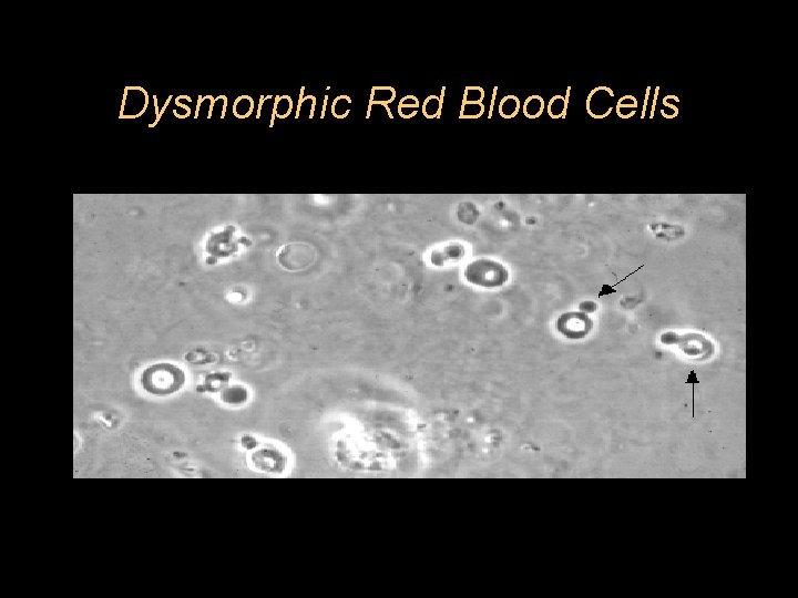 Dysmorphic Red Blood Cells 