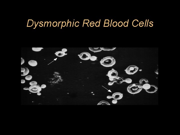 Dysmorphic Red Blood Cells 