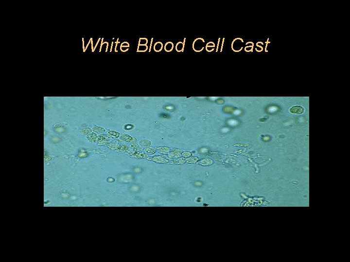 White Blood Cell Cast 