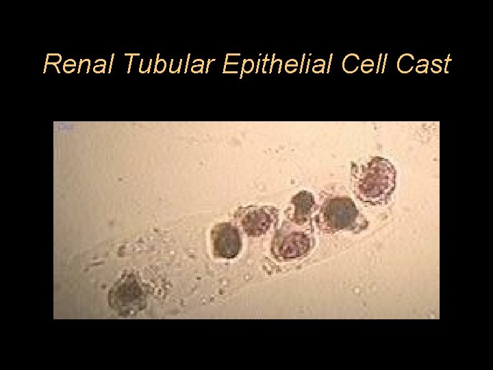 Renal Tubular Epithelial Cell Cast 