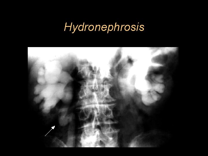 Hydronephrosis 