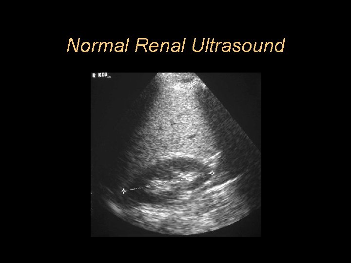 Normal Renal Ultrasound 