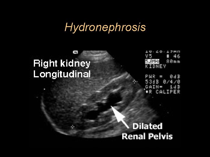 Hydronephrosis 