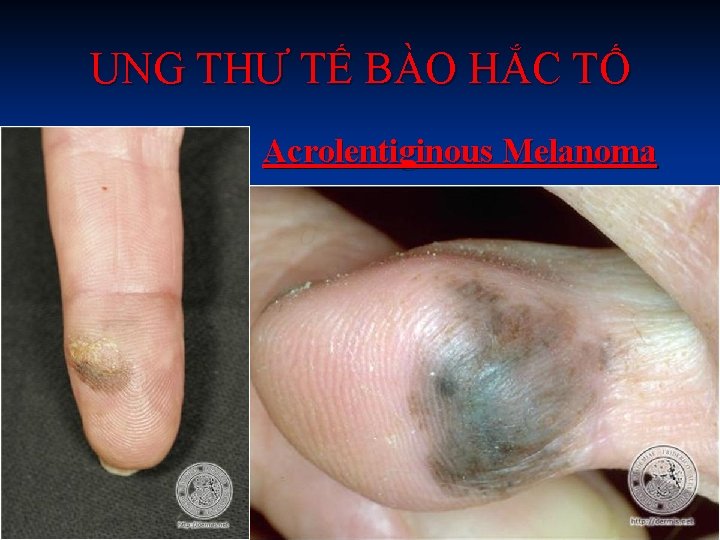 UNG THƯ TẾ BÀO HẮC TỐ Acrolentiginous Melanoma 