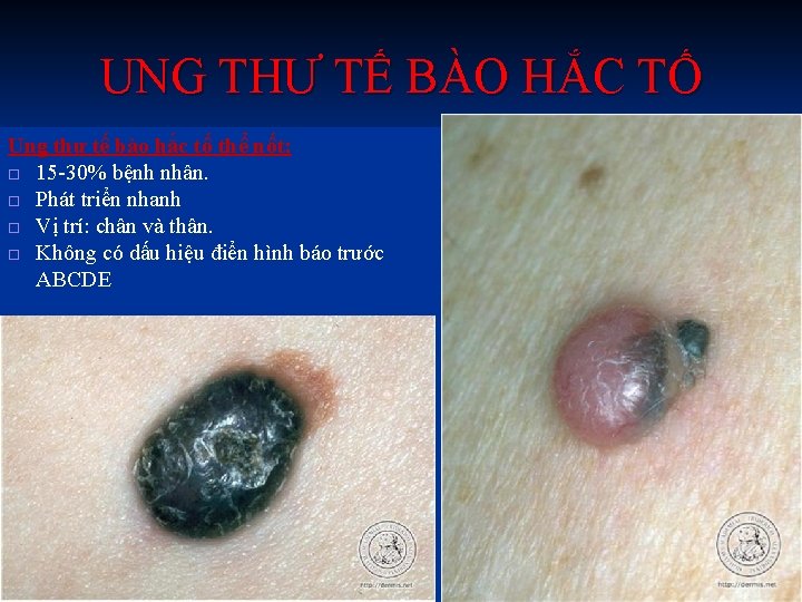 UNG THƯ TẾ BÀO HẮC TỐ Ung thư tế bào hắc tố thể nốt: