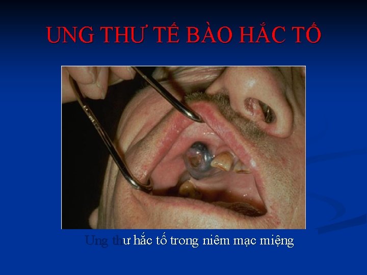 UNG THƯ TẾ BÀO HẮC TỐ Ung thư hắc tố trong niêm mạc miệng