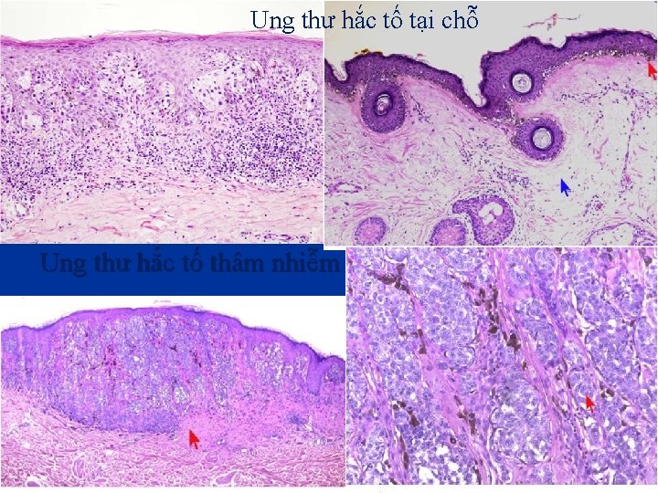 Ung thư hắc tố tại chỗ Ung thư hắc tố thâm nhiễm 