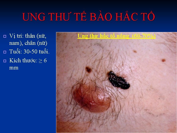 UNG THƯ TẾ BÀO HẮC TỐ Vị trí: thân (nữ, nam), chân (nữ) Tuổi: