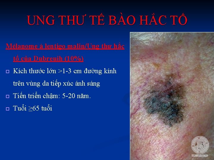 UNG THƯ TẾ BÀO HẮC TỐ Mélanome à lentigo malin/Ung thư hắc tố của