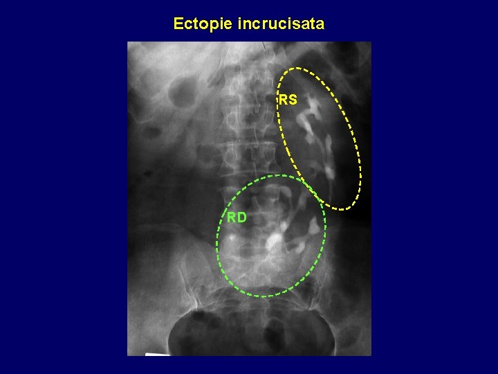 Ectopie incrucisata RS RD 