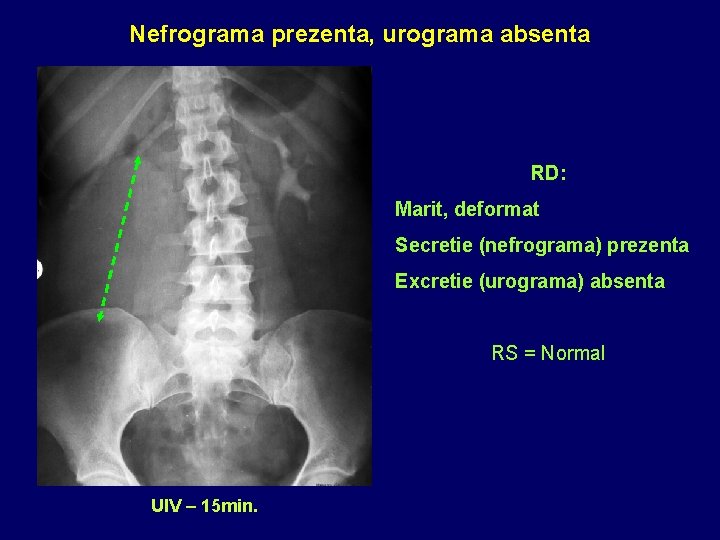 Nefrograma prezenta, urograma absenta RD: Marit, deformat Secretie (nefrograma) prezenta Excretie (urograma) absenta RS