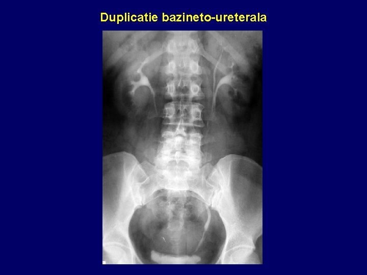 Duplicatie bazineto-ureterala 