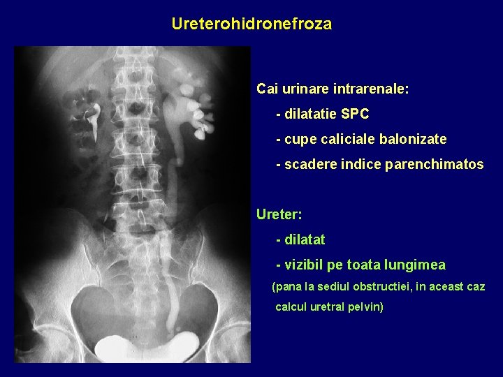 Ureterohidronefroza Cai urinare intrarenale: - dilatatie SPC - cupe caliciale balonizate - scadere indice
