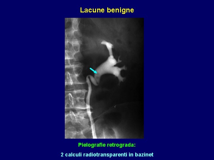 Lacune benigne Pielografie retrograda: 2 calculi radiotransparenti in bazinet 