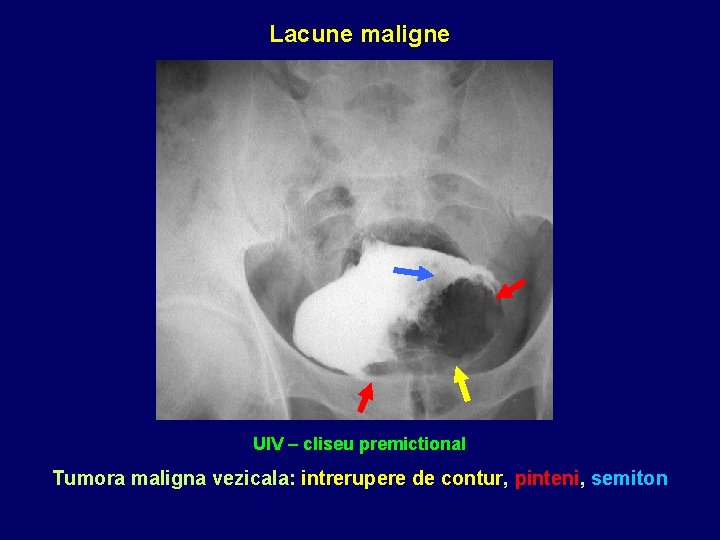 Lacune maligne UIV – cliseu premictional Tumora maligna vezicala: intrerupere de contur, pinteni, semiton