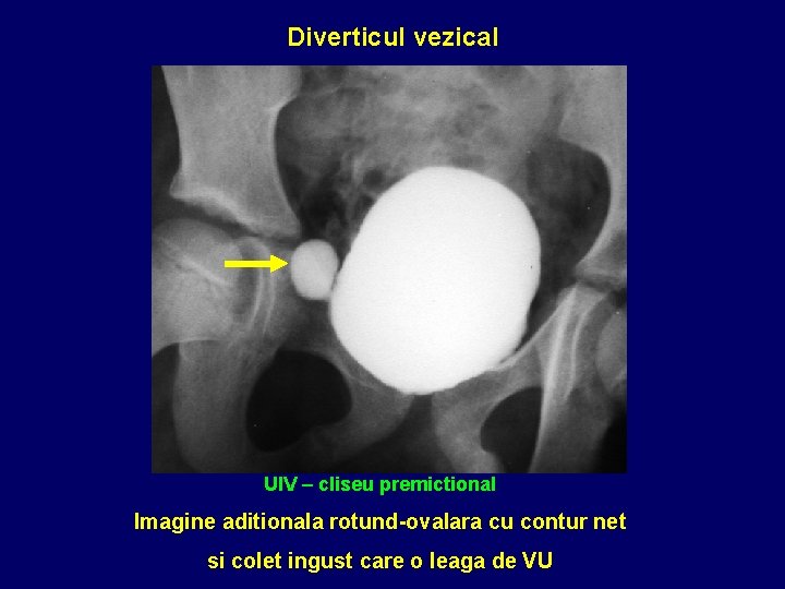 Diverticul vezical UIV – cliseu premictional Imagine aditionala rotund-ovalara cu contur net si colet