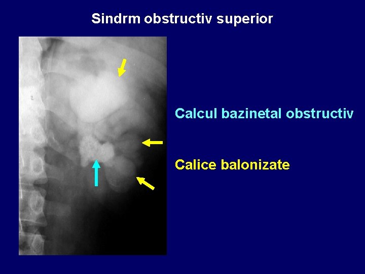 Sindrm obstructiv superior Calcul bazinetal obstructiv Calice balonizate 