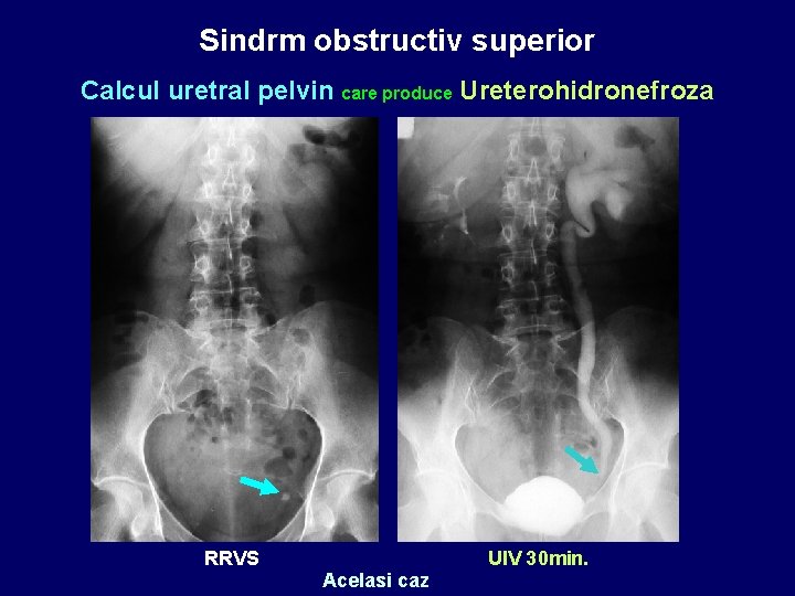 Sindrm obstructiv superior Calcul uretral pelvin care produce Ureterohidronefroza RRVS Acelasi caz UIV 30