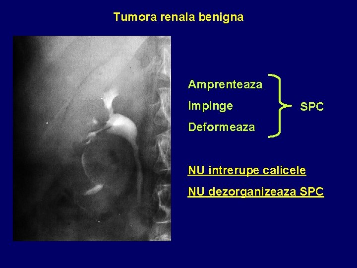 Tumora renala benigna Amprenteaza Impinge SPC Deformeaza NU intrerupe calicele NU dezorganizeaza SPC 
