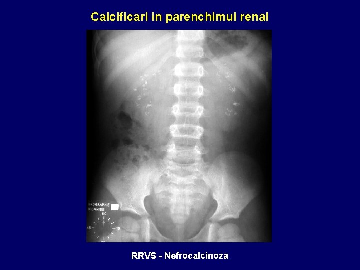 Calcificari in parenchimul renal RRVS - Nefrocalcinoza 