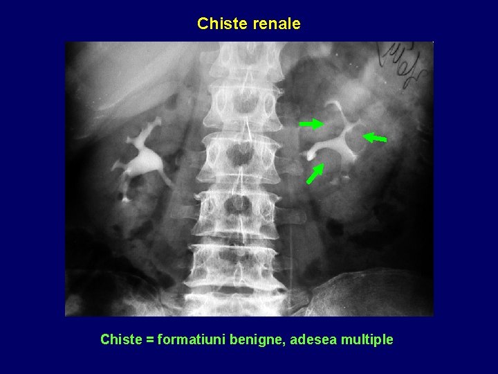 Chiste renale Chiste = formatiuni benigne, adesea multiple 