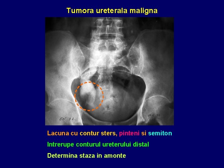 Tumora ureterala maligna Lacuna cu contur sters, pinteni si semiton Intrerupe conturul ureterului distal